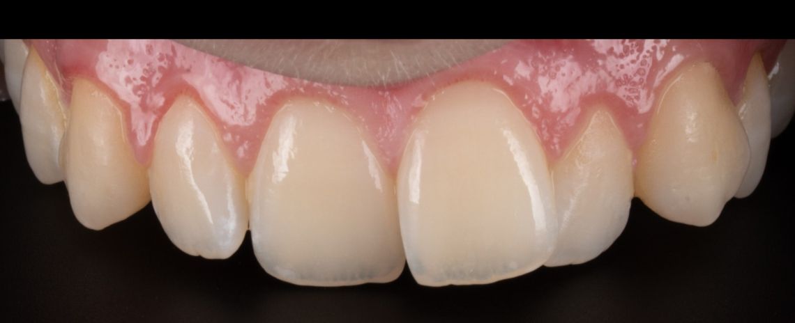 Smile Makeover crowns, veneers, whitening Before