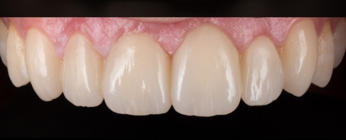Smile Makeover crowns, veneers, whitening After