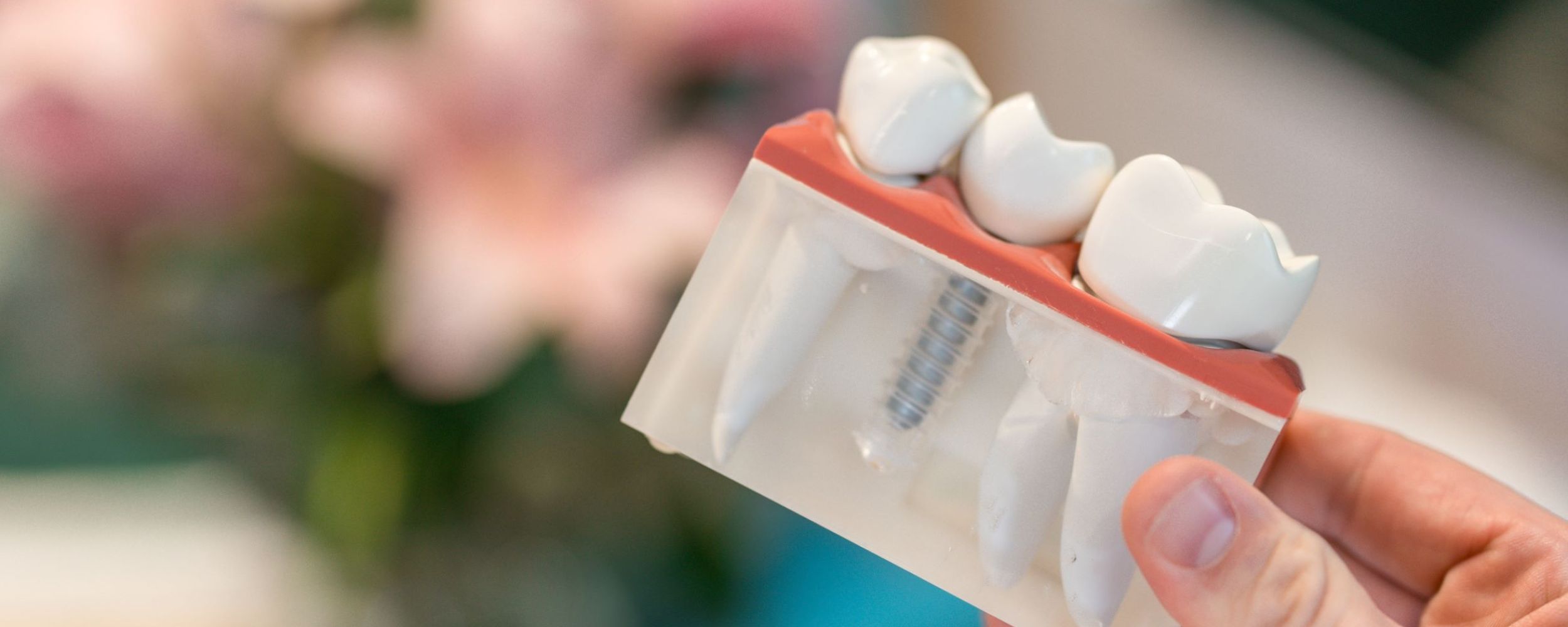 Dental implant journey