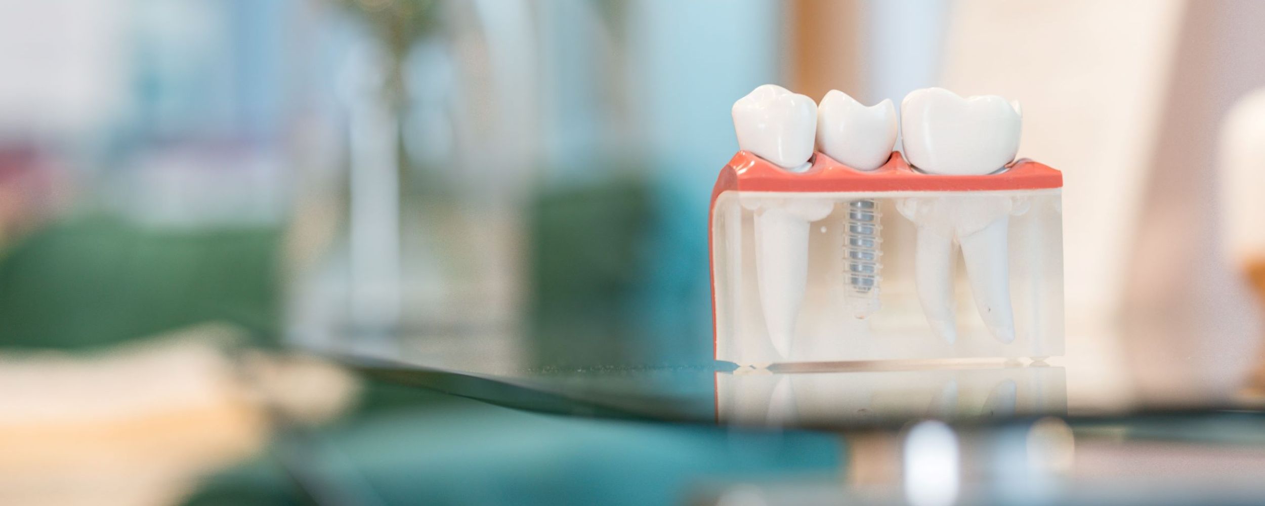 Dental implants