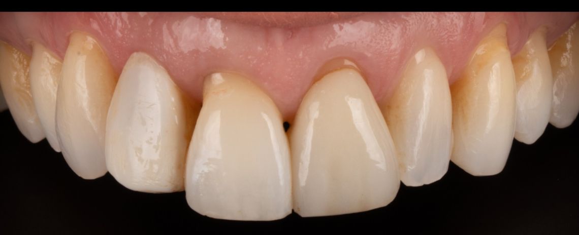 Smile Makeover crowns, veneers, whitening Before