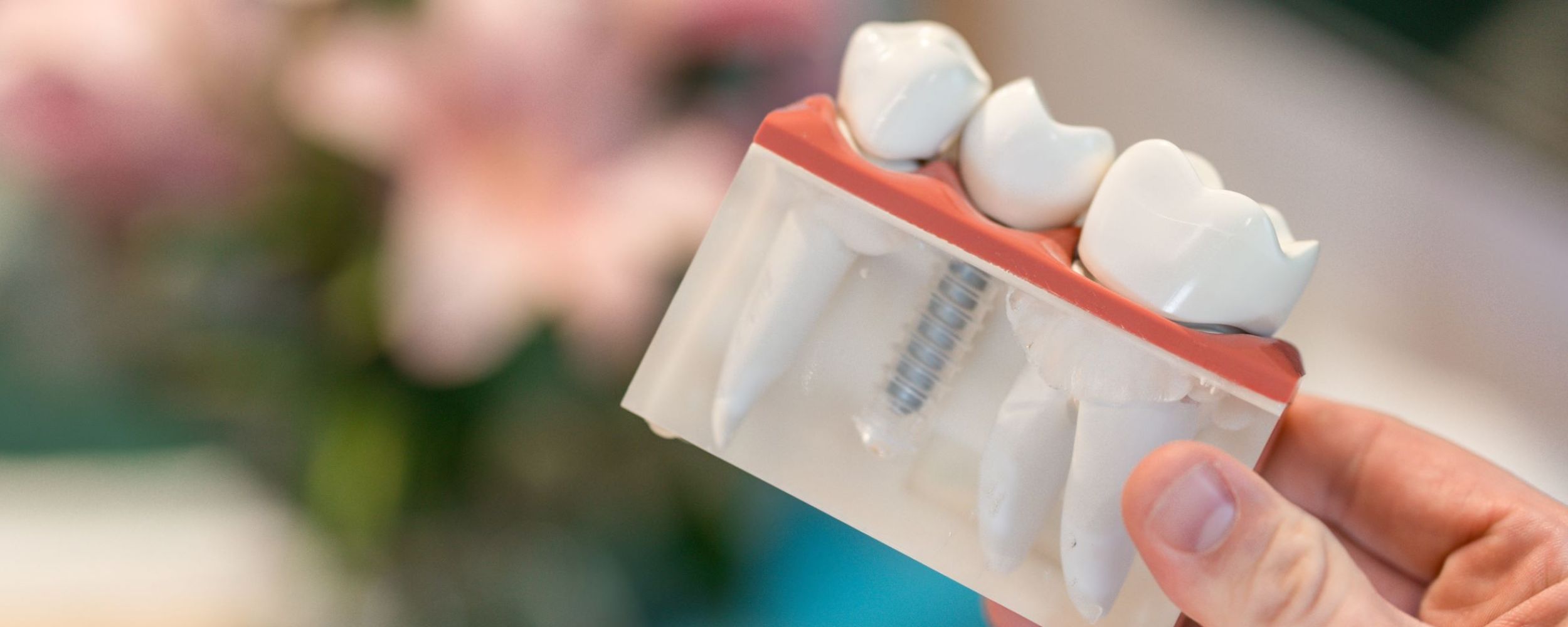 Single tooth dental implants