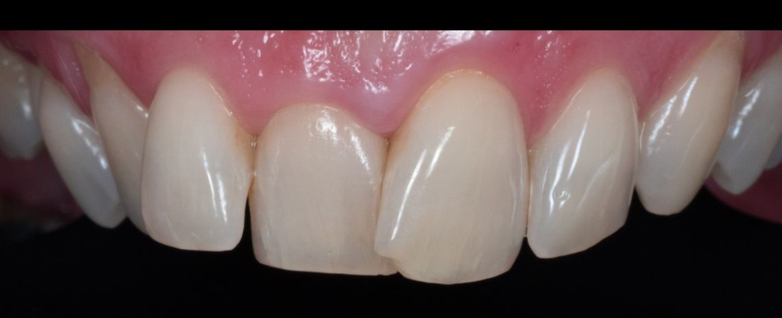 Smile makeover Before