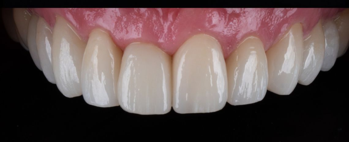 Smile makeover After