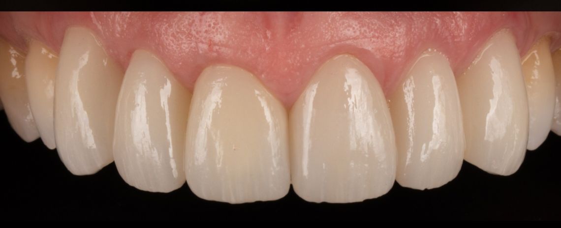 replacement crowns/veneers After