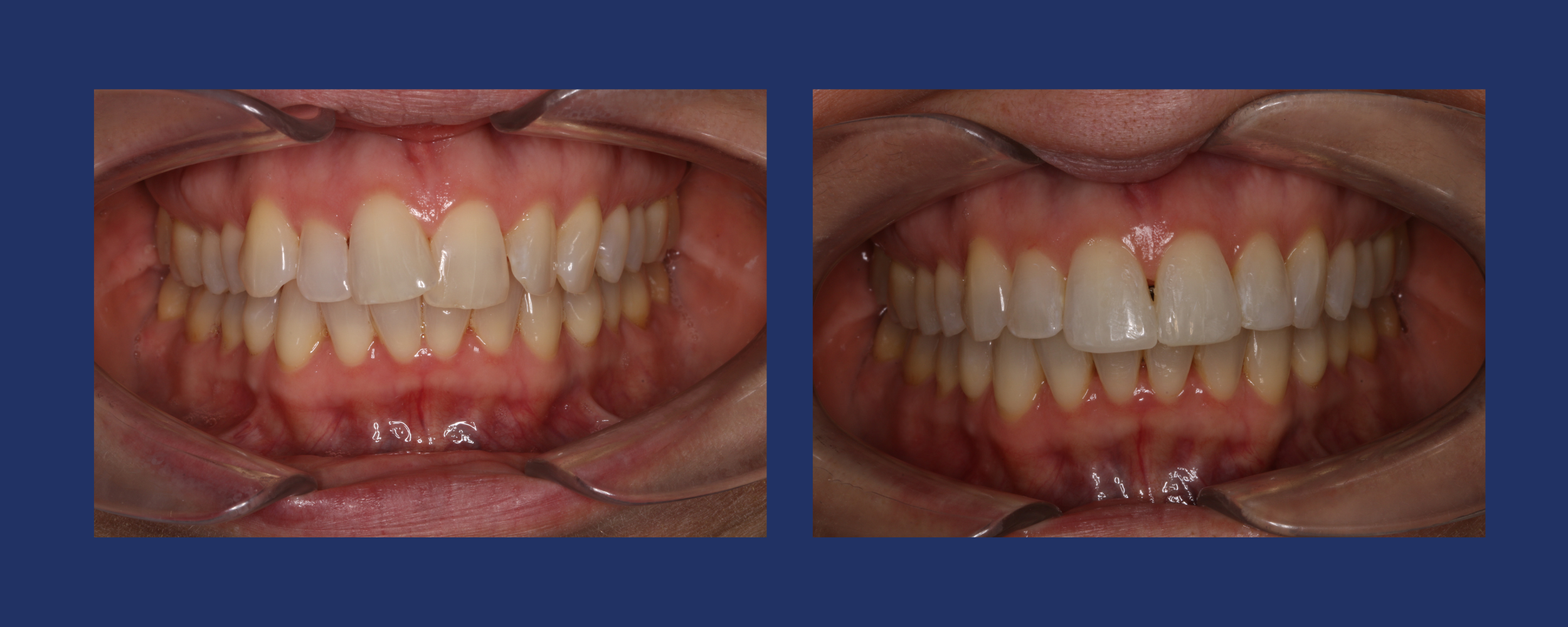 erica's orthodontic journey