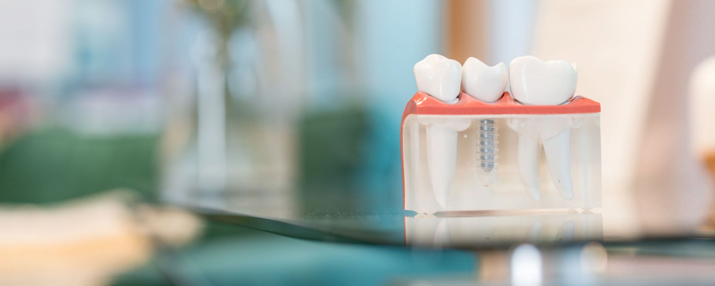 Multiple teeth dental implants