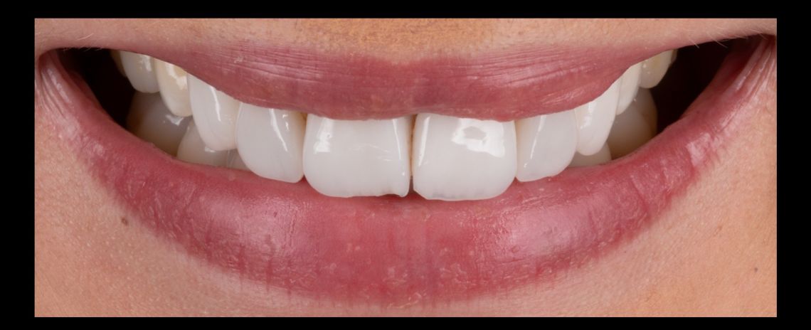 Smile Makeover crowns, veneers, whitening Before