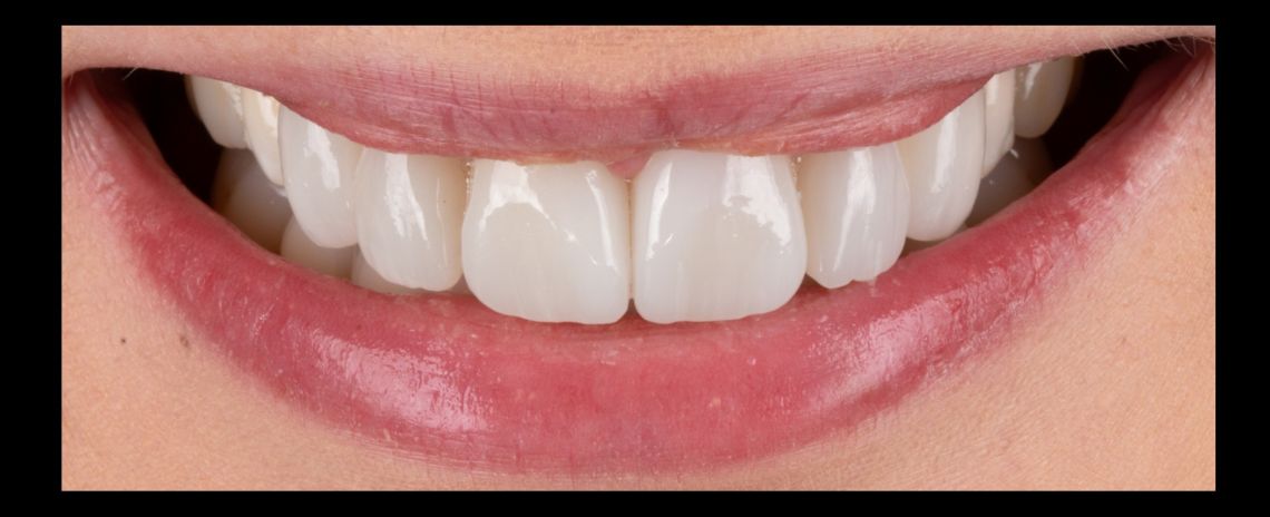 Veneers After