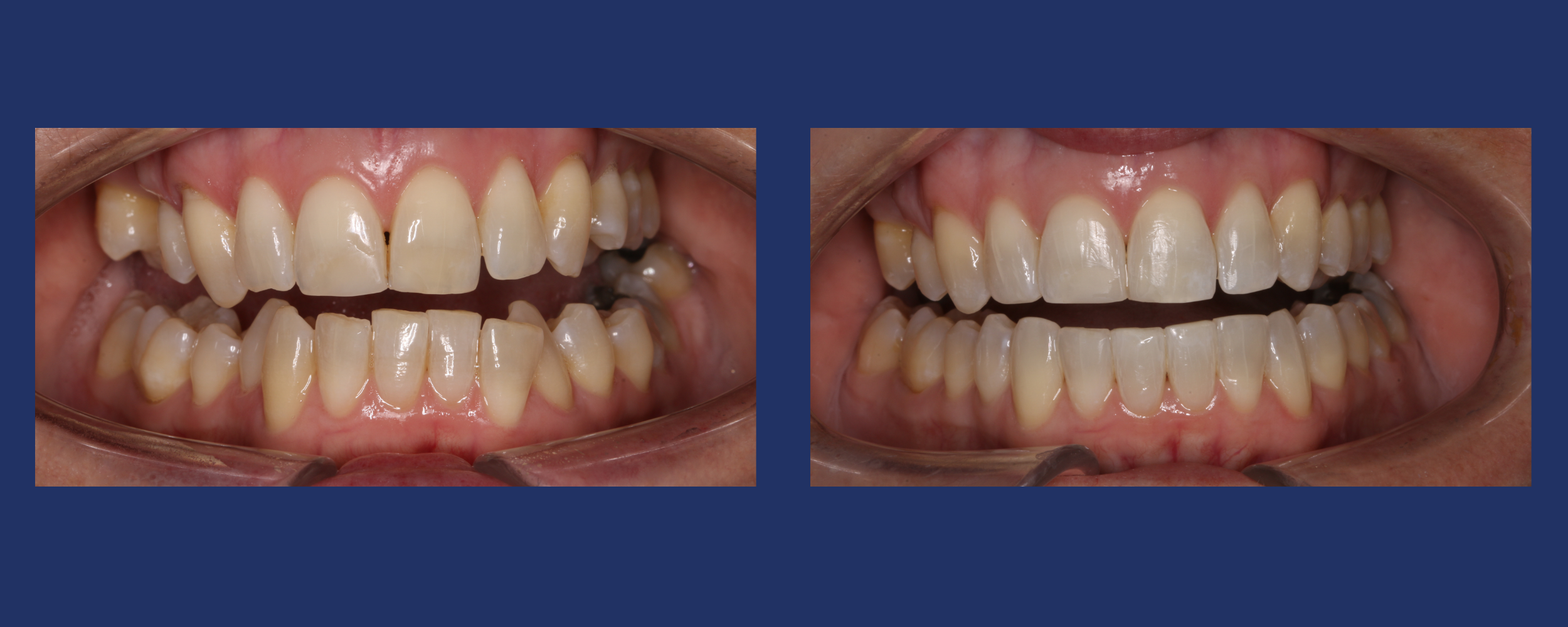 Vanessa's orthodontic journey